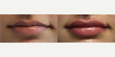 25-34 year old woman treated with Lip Fillers, Juvederm, Volbella, Restylane, Restylane Kysse - Lip augmentation with hyaluronic acid filler (Juvederm, Vollure, Volbella, Voluma, Restylane or Belotero) for balanced natural look & pout
