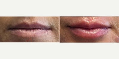 25-34 year old woman treated with Lip Fillers, Juvederm, Volbella, Restylane, Restylane Kysse - Lip augmentation with hyaluronic acid filler (Juvederm, Vollure, Volbella, Voluma, Restylane or Belotero) for balanced natural look & pout