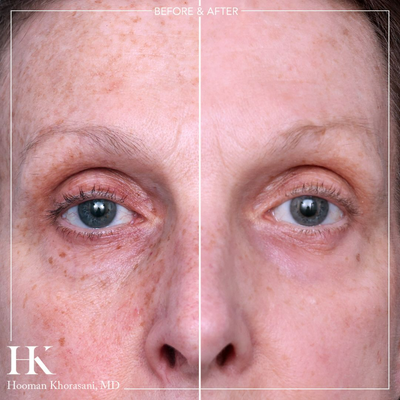 55-64 year old woman treated with TotalFX full face Fractional CO2 laser resurfacing - For more information on this procedure, please visit: https://www.drkhorasani.com/before-and-after-gallery/laser-skin-resurfacing