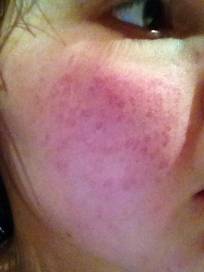 Would CO2 Laser Be the Best Way to Get Rid of my Acne Would CO2 Laser Be the Best Way to Get Rid of my Acne