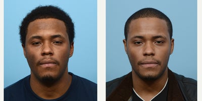 18-24 year old man treated with PicoWay - picoway for hyperpigmentation