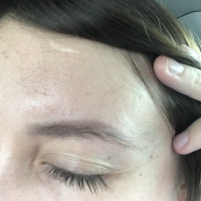 Removing Eyebrow Tattoo With Saline Review Realself
