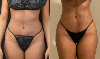 Woman treated with Liposuction - Woman treated with Liposuction