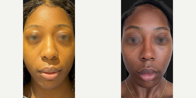 Woman treated with Rhinoplasty, African American Rhinoplasty - Check out our patient 6 months post-op! Its essentially the same nose, now refined with sleek, enhanced definition. We performed an open rhinoplasty using Piezo to rasp the dorsum, augmented the bridge with diced cartilage wrapped in fascia, and supported the tip with cartilage.