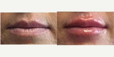 25-34 year old woman treated with Juvederm, Lip Fillers, Restylane, Restylane Kysse, Volbella - Lip augmentation with hyaluronic acid filler (Juvederm, Vollure, Volbella, Voluma, Restylane or Belotero) for balanced natural look & pout