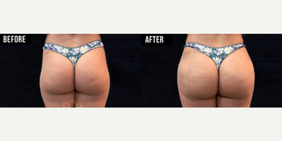Woman treated with Nonsurgical Butt Lift - Results you can get with Butt and Hip Fillers. No surgery, just dermal fillers.