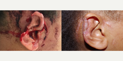 17 or under year old female treated with Facial Reconstructive Surgery - 8 year old female received reconstructive surgery to the ear following an injury; photos depict the patient's results 2 months post-op.