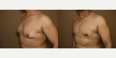 35-44 year old man treated with Male Breast Reduction - gynecomastia