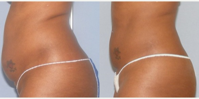 UltraShape - UltraShape