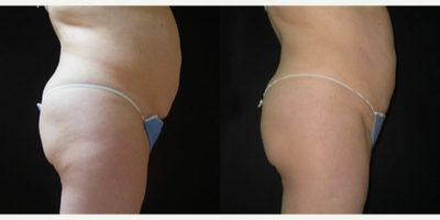 UltraShape - UltraShape