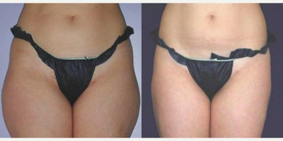 UltraShape - UltraShape