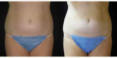 UltraShape - UltraShape