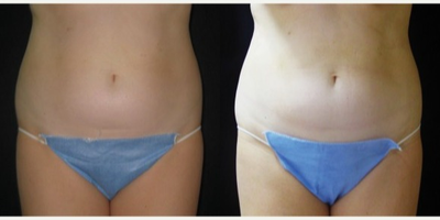 UltraShape - UltraShape