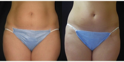 UltraShape - UltraShape