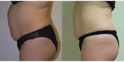UltraShape - UltraShape