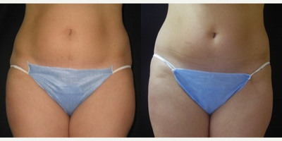 UltraShape - UltraShape