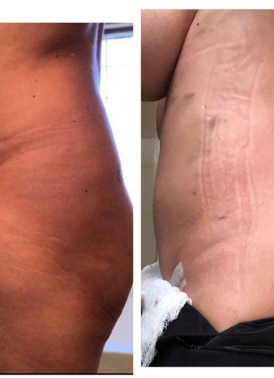 Mons Pubis Reduction Before & After Animation - Video - RealSelf