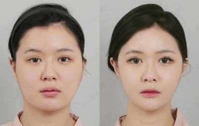 25-34 year old woman treated with V Line Surgery - Square Jaw Surgery + High L Cheekbone Reduction in ID hospital