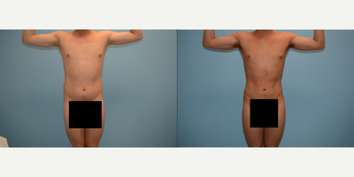 25-34 year old man treated with Butt Augmentation - A 27 year old male who underwent liposuction to his abdomen, flanks, and chest with a fat transfer to his buttocks for volume and projection. A total of 600cc was injected into each buttock cheek. This photo was taken three months post operative surgery.