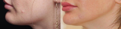 Forma / Fractora - This client wanted a more refined Jawline this was accomplished using Forma and Fractora as a combination treatment.