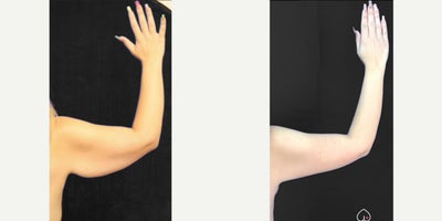 35-44 year old female treated with Arm Lift, Liposuction, Vaser Liposuction - Arm Lift with Vaser Liposuction
