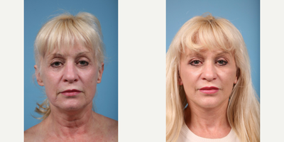 Woman treated with Lower Facelift - Woman treated with Lower Facelift