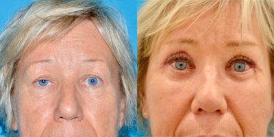 55-64 year old woman treated with Eyelid Surgery, Ptosis Surgery - Female patient treated with Eyelid Surgery , Ptosis Surgery.