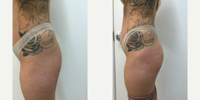25-34 year old woman treated with Sculptra Aesthetic to the Buttocks - Sculptra Butt Lift