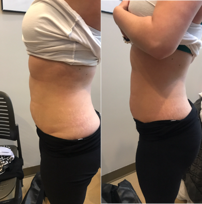 25-34 year old woman treated with Body Wrap - This was taken on the same day as the skin firming/toning treatment, before and after. This patient was following a diet and exercise program.