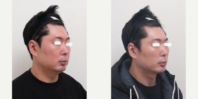 35-44 year old man treated with AccuLift, Liposuction, Laser Liposuction - 39 Years old male patient Chief Complain: Bulky cheeks, overal puffiness and the lack of masculine contours, looking gloomy and more older then his real age. Puffy, tired undereye areaTreatment Plan: undereye fat reposition, face liposuction (double chin, cheek bone, cheeks, near mouth)Outcome: pure fat liposuctioned : double chin (-30cc), middle face line (- 50cc) fresher and more youthful face shape, reduce exessive fat, more refined appearance and masculine shaped jaw line.