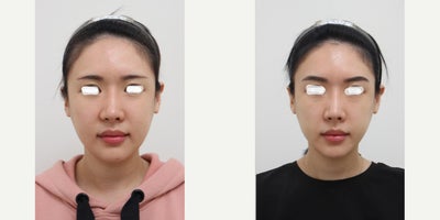 25-34 year old woman treated with AccuLift, Liposuction, Laser Liposuction - 26 Years old female patient Chief Complain: Puffiness and the lack of jaw contours, round shaped face (looking for V-line) Treatment Plan: ace liposuction (double chin, cheek bone, cheeks, near mouth)Outcome: pure fat liposuctioned : double chin (-20cc), middle face line (- 40cc) fresher look, V-lined face shape, more refined appearance