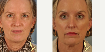45-54 year old woman treated with Phenol Peel - HETTER PEEL SKIN RESURFACING, Baker-Gordon Phenol Peel by Burke Robinson MD, FACS