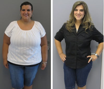 Before & After - 
	12 months post-op
