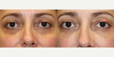44 year old woman treated with Voluma to the Lower Eyelid Region - 44 year old woman treated with Voluma to the Lower Eyelid Region