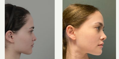 18-24 year old woman treated with Cheekbone Reduction, Forehead Reduction, Rhinoplasty, V Line Surgery - .