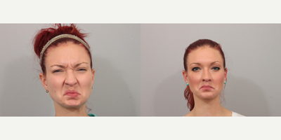 Botox - Botox Treatment