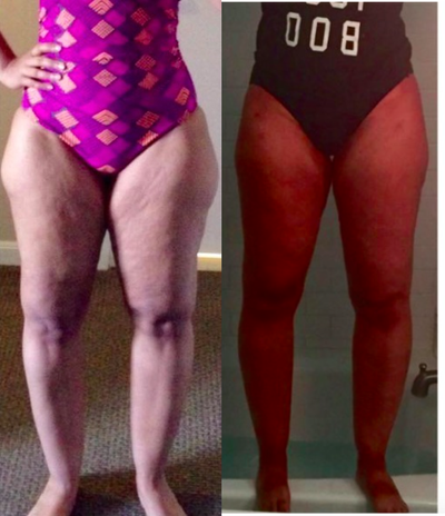35-44 year old woman treated with Liposuction - vaser and body jet liposculpture of the thighs/legs in a patient with lipedema. see the transition from before, 2 weeks and 6 weeks after treatment.