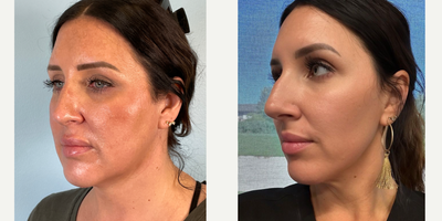 25-34 year old woman treated with Buccal Fat Removal, Chin Implant, Jawline Sculpting, and nose threads - Cheekago with nose threads!