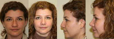 Nose job or Rhinoplasty - 
	This young patient was not happy with her bump on her nose and droopy tip. Performed a rhinoplasty or nose job on her to improve her nose.
