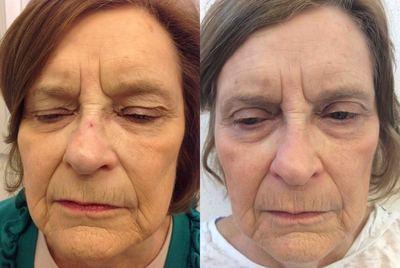 Mohs Surgery - Mohs surgery performed on a basal cell