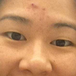 taiwan eyelid surgery