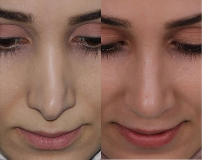 Woman treated with Revision Rhinoplasty - Woman treated with Revision Rhinoplasty