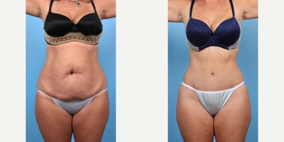 48 year old woman treated with Liposuction - 48 year old woman treated with Tummy Tuck and Liposuction to abdomen, waist, andmons area. Pre-op, patient had two pregnancies, she was able to maintain her weight through diet and limited exercise but she was still bothered. She is 5'7 tall and weighed 167 lbs.