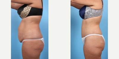 48 year old woman treated with Tummy Tuck - 48 year old woman treated with Tummy Tuck and Liposuction to abdomen, waist, and mons area. Pre-op, patient had two pregnancies, she was able to maintain her weight through diet and limited exercise but she was still bothered. She is 5'7 tall and weighed 167 lbs.