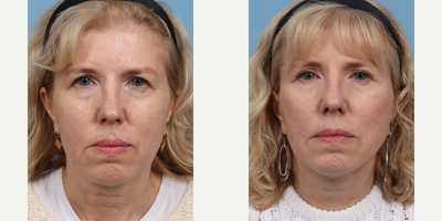 55-64 year old woman treated with Deep Plane Facelift, Eyelid Surgery - Deep Plane Facelift and Upper Eyelid Blepharoplasty