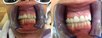 Dental Bonding (Top Teeth) - Patient with multiple cavities and browning of teeth from years of staining. Patient's teeth were transformed in only one appointment at our office with composite veneers. Of course porcelain veneers are a much more permanent solution, lasting more than 20 years, this patient opted for dental bonding (also known as composite veneers) which is more of a temporary fix and cost only a fraction of porcelain veneers. This case was done entirely by Sarah Thompson, DMD.