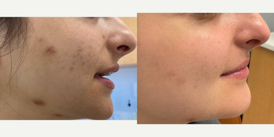 18-24 year old woman treated with Spironolactone For Acne - Before and after acne