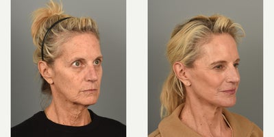 55-64 year old woman treated with Facelift, Laser Resurfacing - 60 year old female who underwent facelift, neck lift and Co2 laser resurfacing of her face and neck 3 months ago.