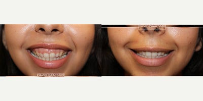 18-24 year old woman treated with Botox for Gummy Smile - This young lady with severe gummy smile underwent treatment for a redefined smile, enhanced lip contours, and decreased gingival display with natural results.Gummy smiles, often termed excessive gingival display, result from various factors, including hyperactive upper lip muscles, excessive gum tissue, or abnormal tooth eruption. This aesthetic concern can impact one's confidence.Typically, my initial approach to addressing gummy smiles involves Botox injections due to their minimally invasive nature. Injections can be nuanced and require precision. My specialized injection pattern and technique aim to relax hyperactive muscles effectively. Its important to note injections can lead to complications such as asymmetry, speech difficulties, or unintended facial expressions, so choose an experienced injector.