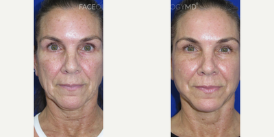 Woman treated with CO2 Laser, Facial, Neck Lift - This patient came to our office seeking facial and skin rejuvenation to reverse signs of aging.To achieve her goals, we performed our signature FaceologyLIFT which was effective in sculpting her jawline, lifting her neck, and tightening her skin. After her procedure, she underwent CO2 Laser Resurfacing to reduce the appearace of sun damage and deep wrinkles while enhancing her overall complexion.
